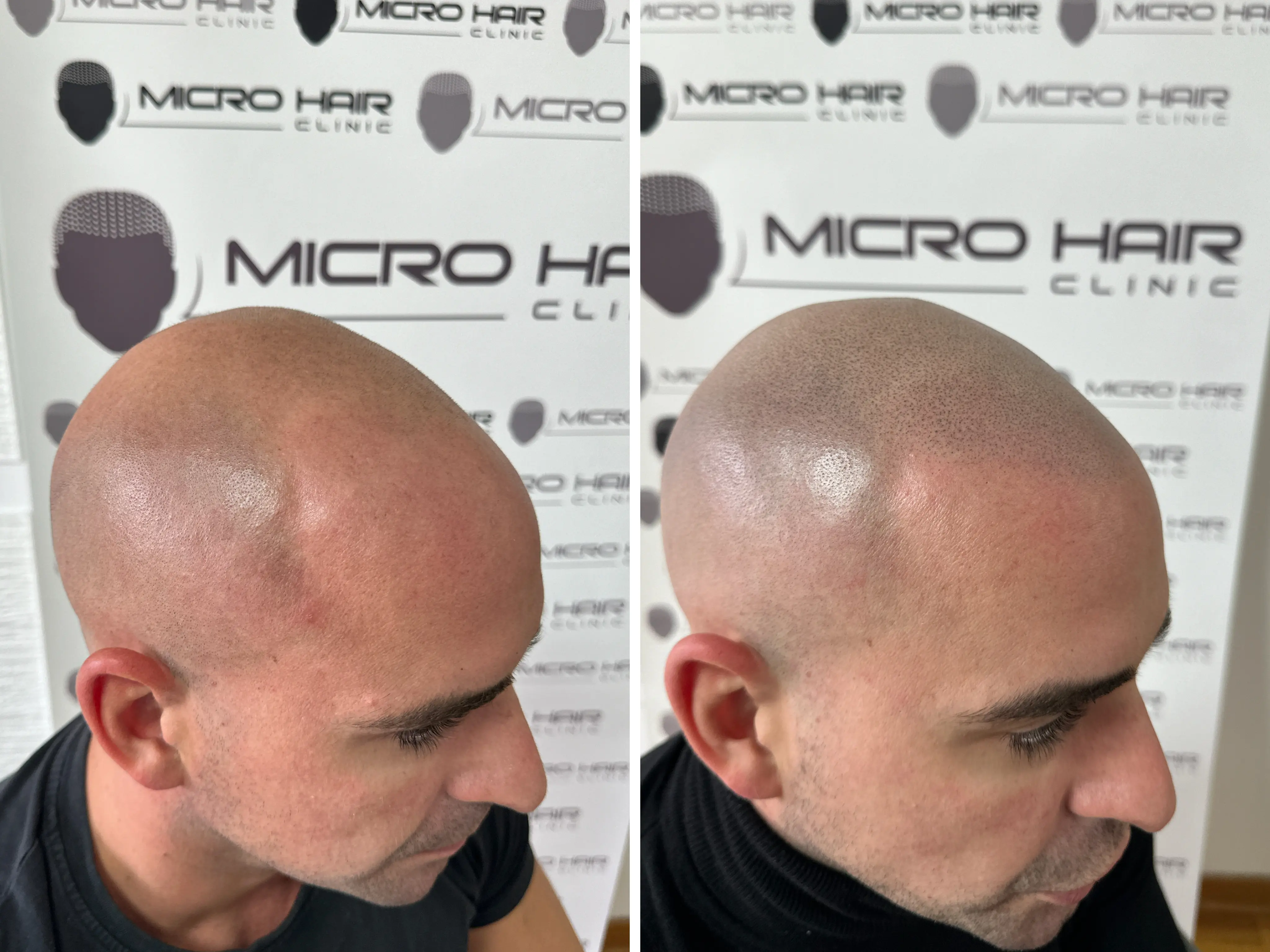 SMP rezultat pred in po - tretman mikropigmentacije 10